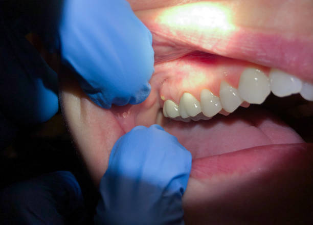Best Emergency Root Canal Therapy in Harwich Center, MA